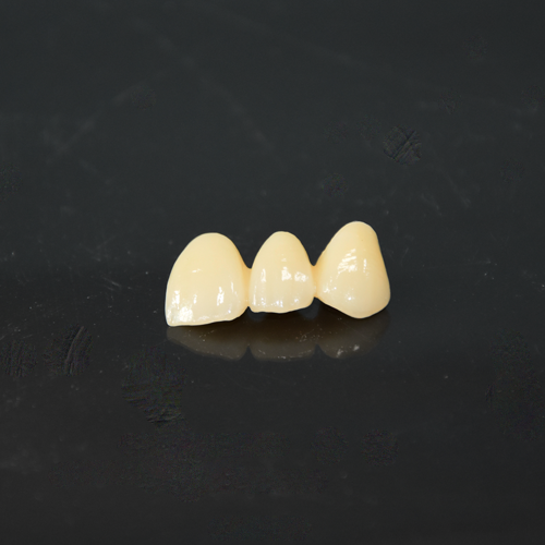 CADCAM zirconia fused to porcelain bridge