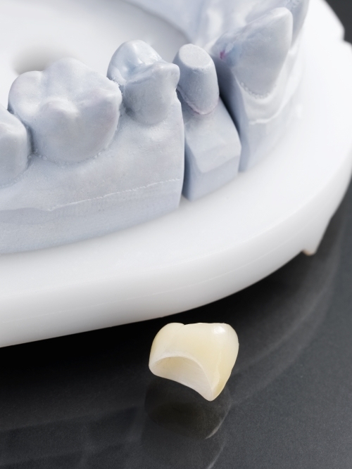 Zirconia Crown