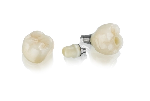 Zirconia Abutment & Custom Abutment with Zirconia Screw Retained Crown