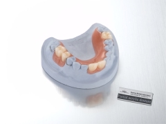 Acrylic Partial Denture