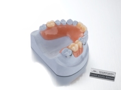 Acrylic Partial Denture