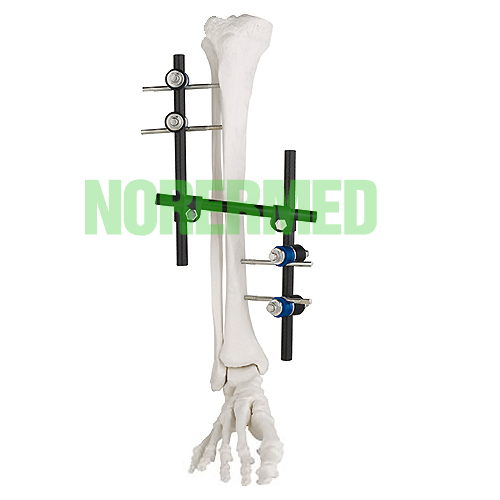 Orthopedic Z type Tibial & Femur External Fixator