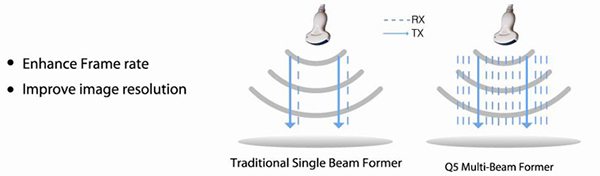 CHISON Q5 MULTI-BEAM FORMER TECHNOLOGY