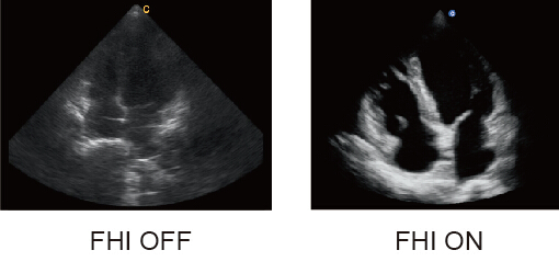 CHISON QBit5 FHI technology greatly improves diagnostic abilities