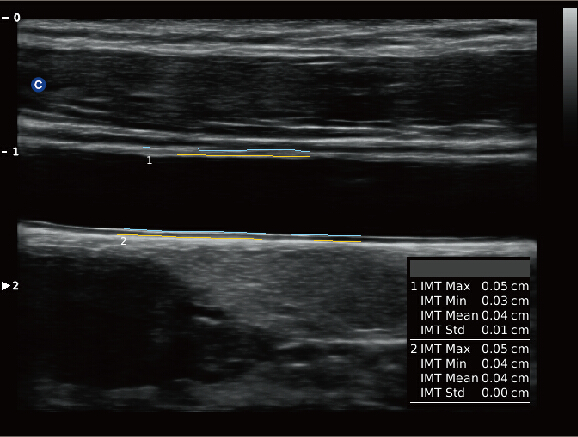 CHISON QBit5 allows you to measure the intima faster,  more easily and more accurately