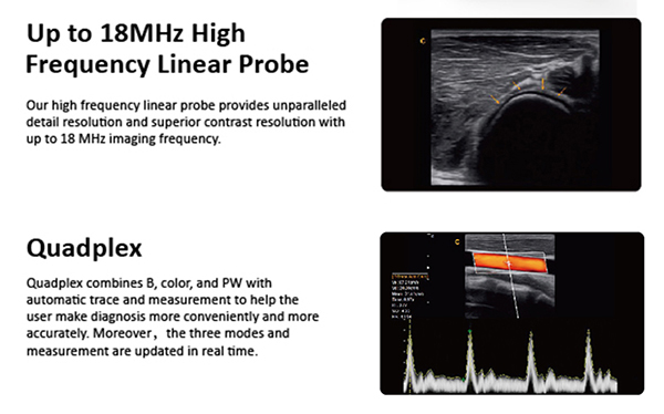 CHISON Q9 18MHz high frequency linear probe