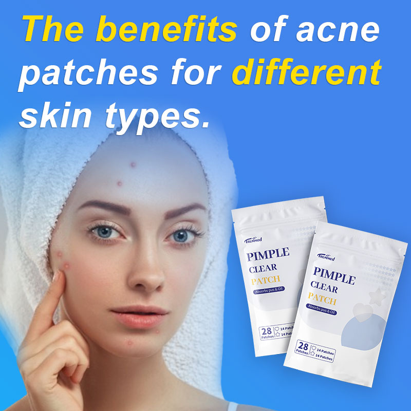 The benefits of acne patches for different skin types