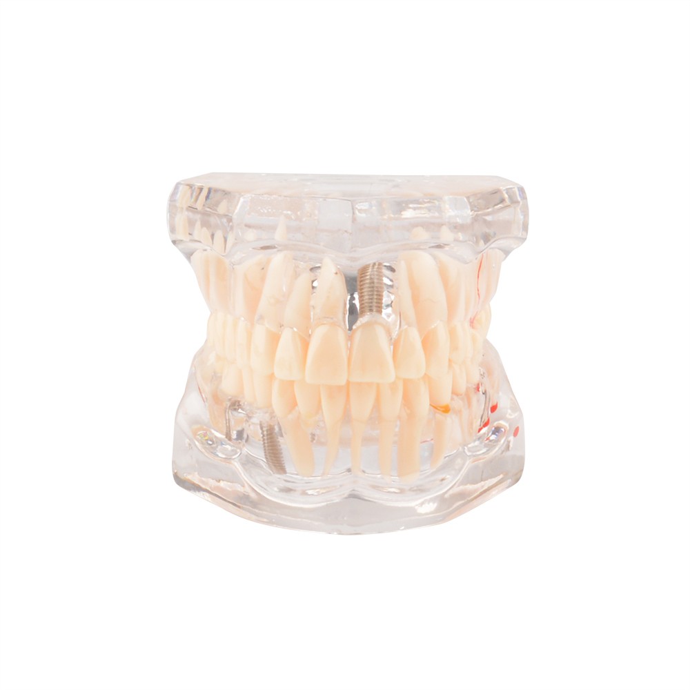 Implant Pathological Teeth Model with Restoration Bridge Tooth for Dental Disease Education