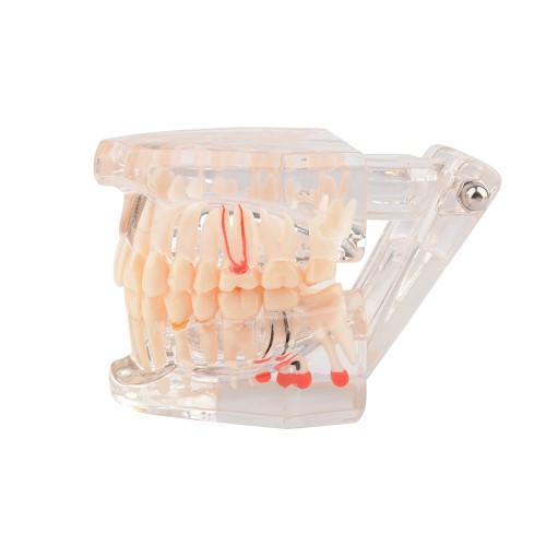 Implant Pathological Teeth Model with Restoration Bridge Tooth for Dental Disease Education