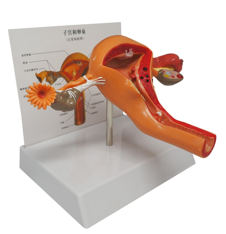 Uterus & Ovary Anatomy Model with Pathologies for Doctors Office Education