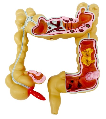 Human Colon Rectum Anatomy Model with Pathologies, Intestine Disease