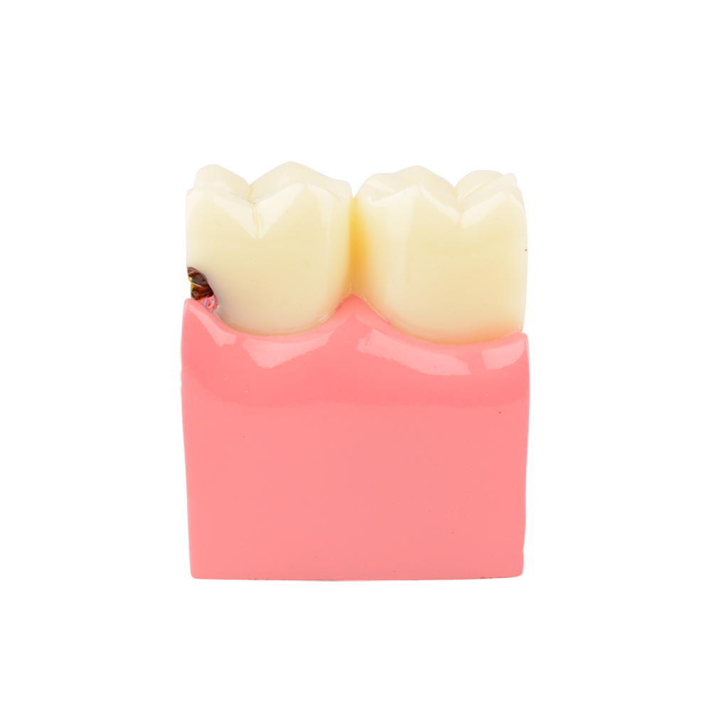 Dental Teeth Decay Model, 6 Times Caries, Comparative Study for Dentist
