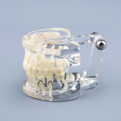 Clear Pathology Teeth Model with Broken Tooth, Root and Gum