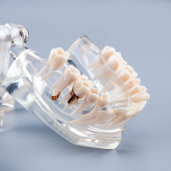 Transparent Disease Teeth Model Missing Gum for Patient & Student Education