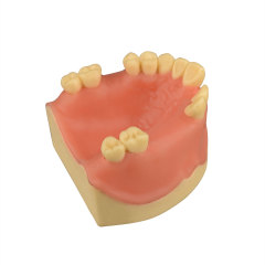Maxillary Dental Implant Model Missing Partial Teeth 15, 21, 14, 15