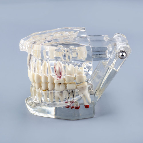 Transparent Teeth Model with Tooth Decay &amp; Pathological Tooth Root