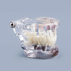 Transparent Pathological Teeth Root Model with Dental Implants