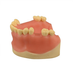 Maxillary Dental Implant Model Missing Partial Teeth 15, 21, 14, 15