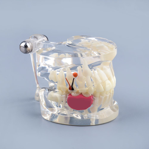 Clear Pathology Teeth Model with Broken Tooth, Root and Gum