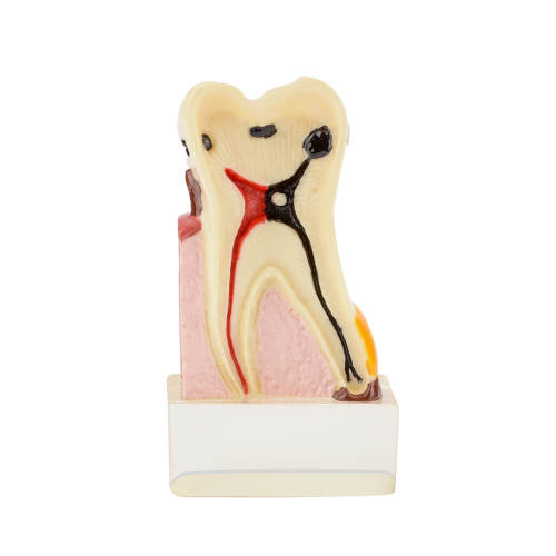 4 Times Tooth Caries Comprehensive Pathological Display Model with Nerve