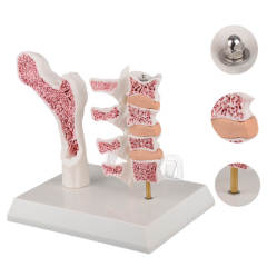 Menopausal Osteoporosis Model (OP Femur & 4 Vertebrae) for Medical Teaching