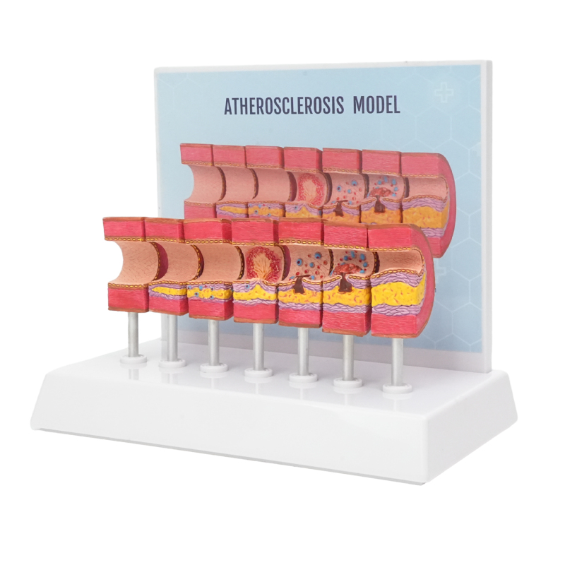 Atherosclerosis Model with 6 Evolutionary Stages