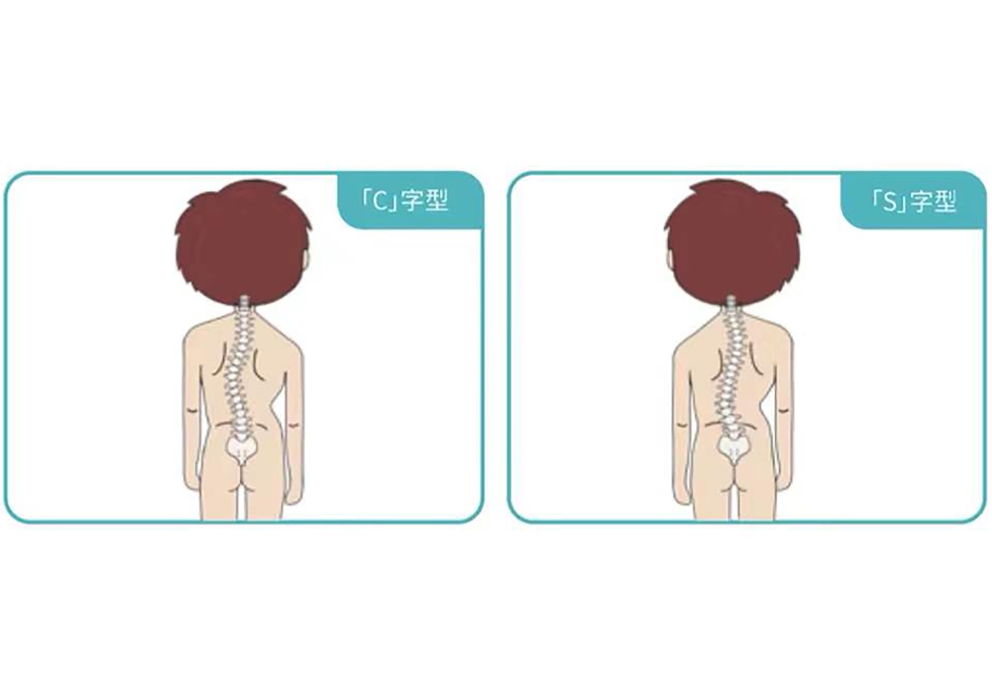 我国已将脊柱侧弯筛查纳入学生常规体检
