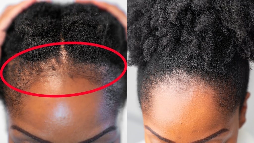 How To Grow Back Edges Fast