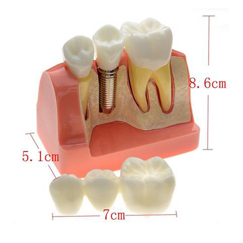 Dental Removable Implant Study Analysis Crown Bridge Demonstration Teeth Model