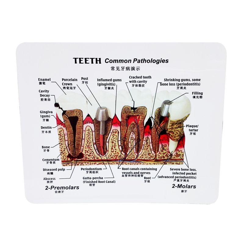 Dental Detachable Caries Demonstration Anatomical Teeth Common Pathologies Model