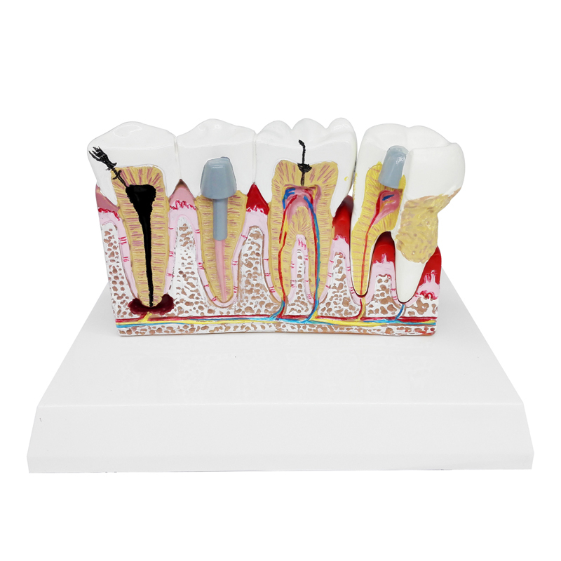 Dental Detachable Caries Demonstration Anatomical Teeth Common Pathologies Model