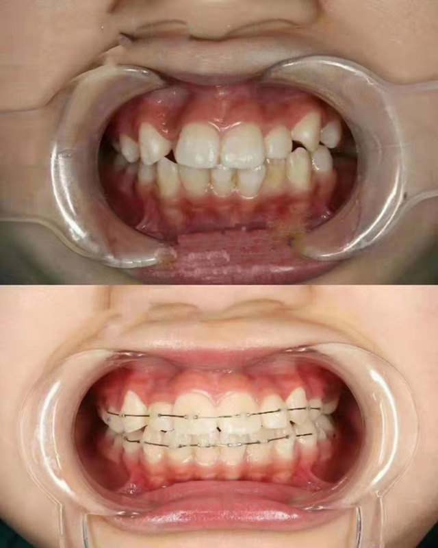 Dental Orthodontic Mini Stops tube Crimpable Hooks Bracket Stopper 0.5/0.8mm