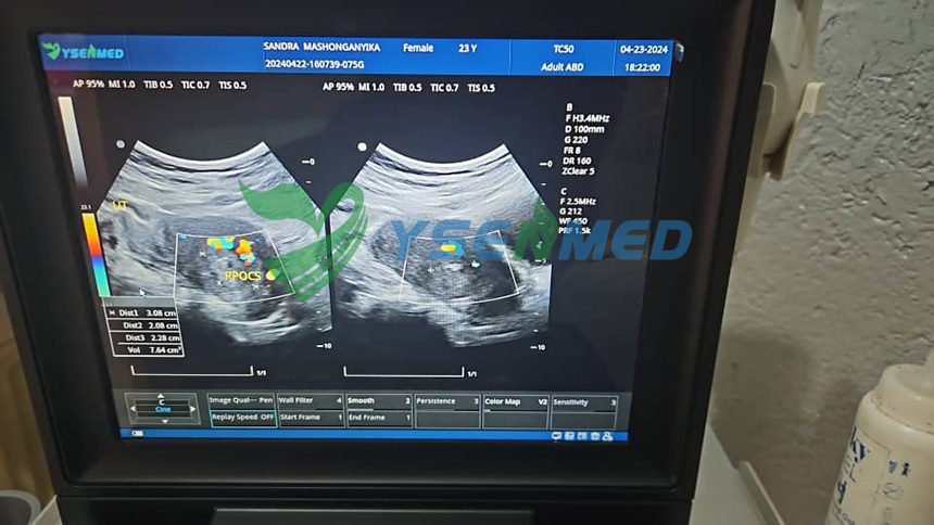 YSENMED YSB-M5 portable color doppler ultrasound working well in a Zimbabwean hospital.
