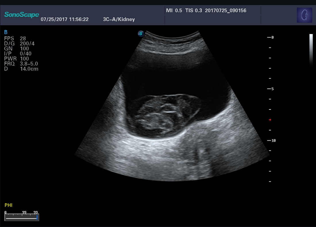 Sonoscape P40 Trolley Color Doppler Ultrasound