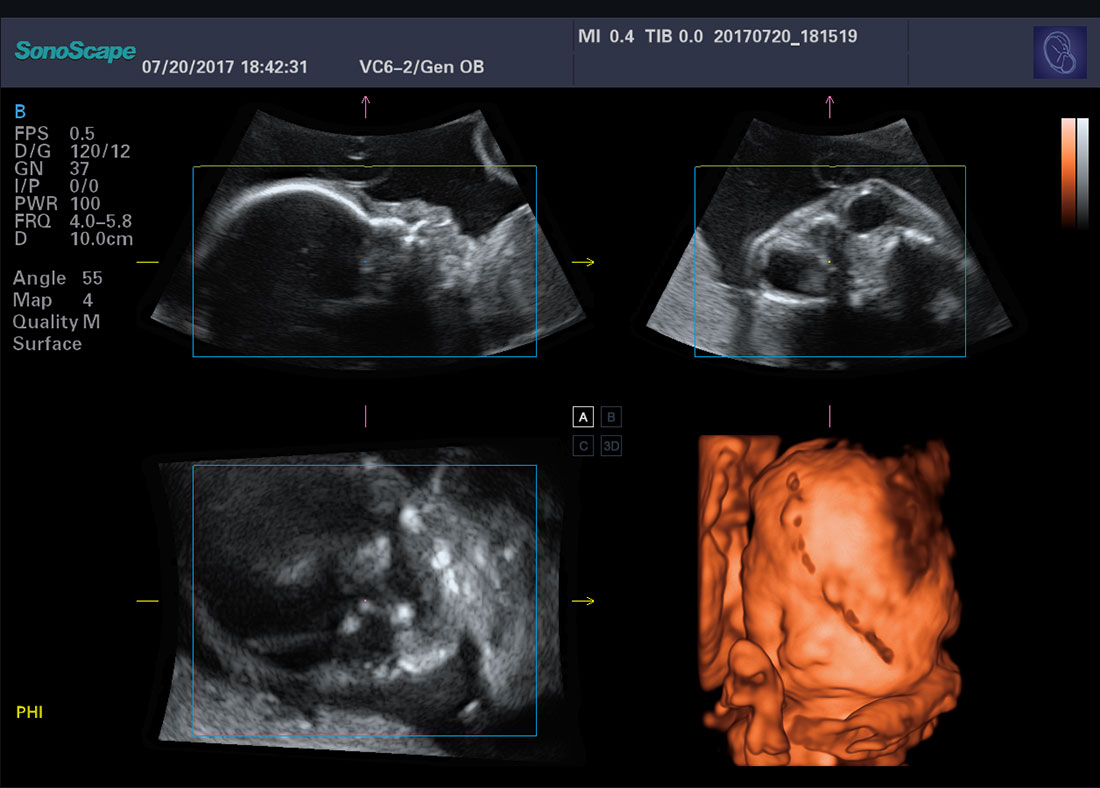 Sonoscape P40 Trolley Color Doppler Ultrasound
