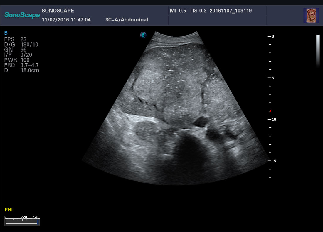 Sonoscape P40 Trolley Color Doppler Ultrasound