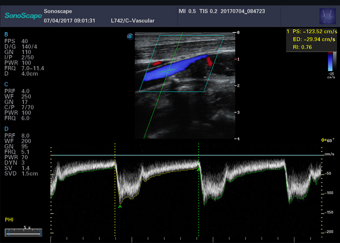 Sonoscape P40 Trolley Color Doppler Ultrasound