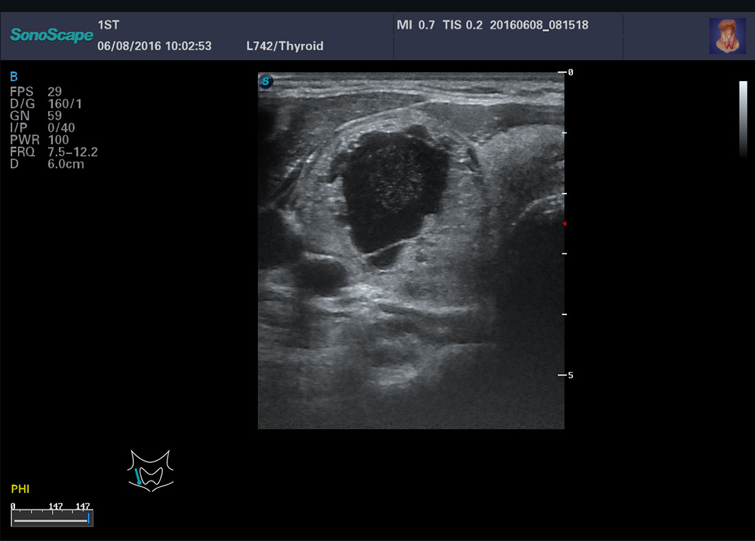 Sonoscape P40 Trolley Color Doppler Ultrasound