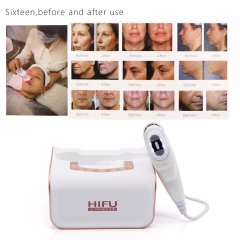 RF hifu Radio Frequency Skin Tightening for Face and Body