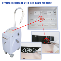 Q Switch Nd Yag Laser Pico Laser Pigment Tattoo Removal Machine