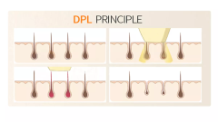 diode depilation machine DPL photon skin rejuvenation lifting anti-wrinkle and beauty machine
