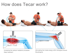 Tecar Therapy Diathermy Machine CET RET For Rehabilitator Sport Tecar Machine