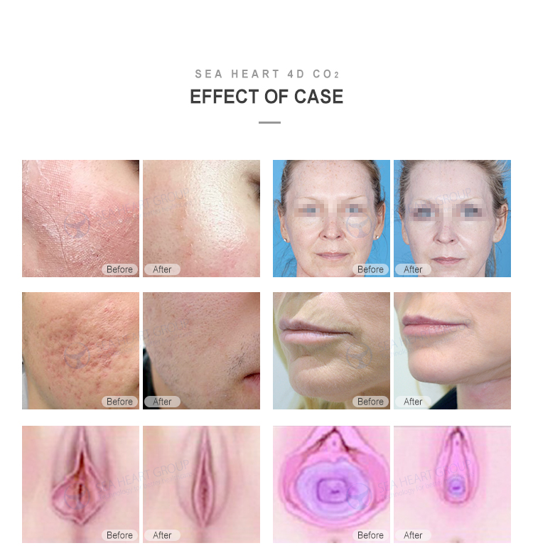 tightening skin care beauty co2 fractional laser
