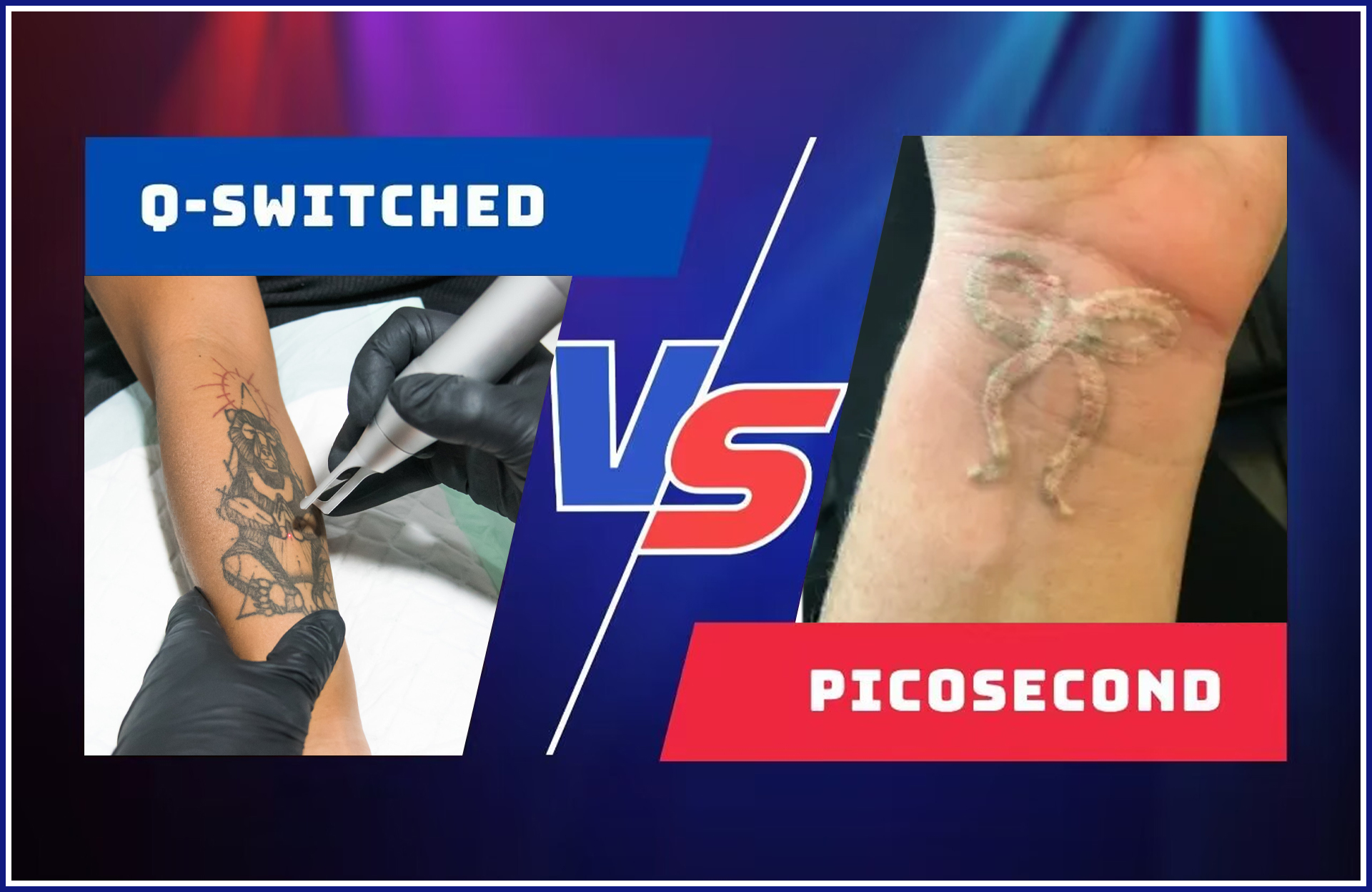 Pico Laser vs Q-Switched Laser: Decoding the Battle of the Lasers