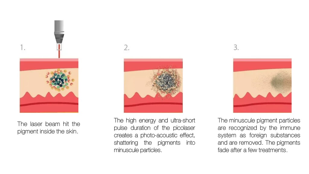 nd yag laser principle of operation