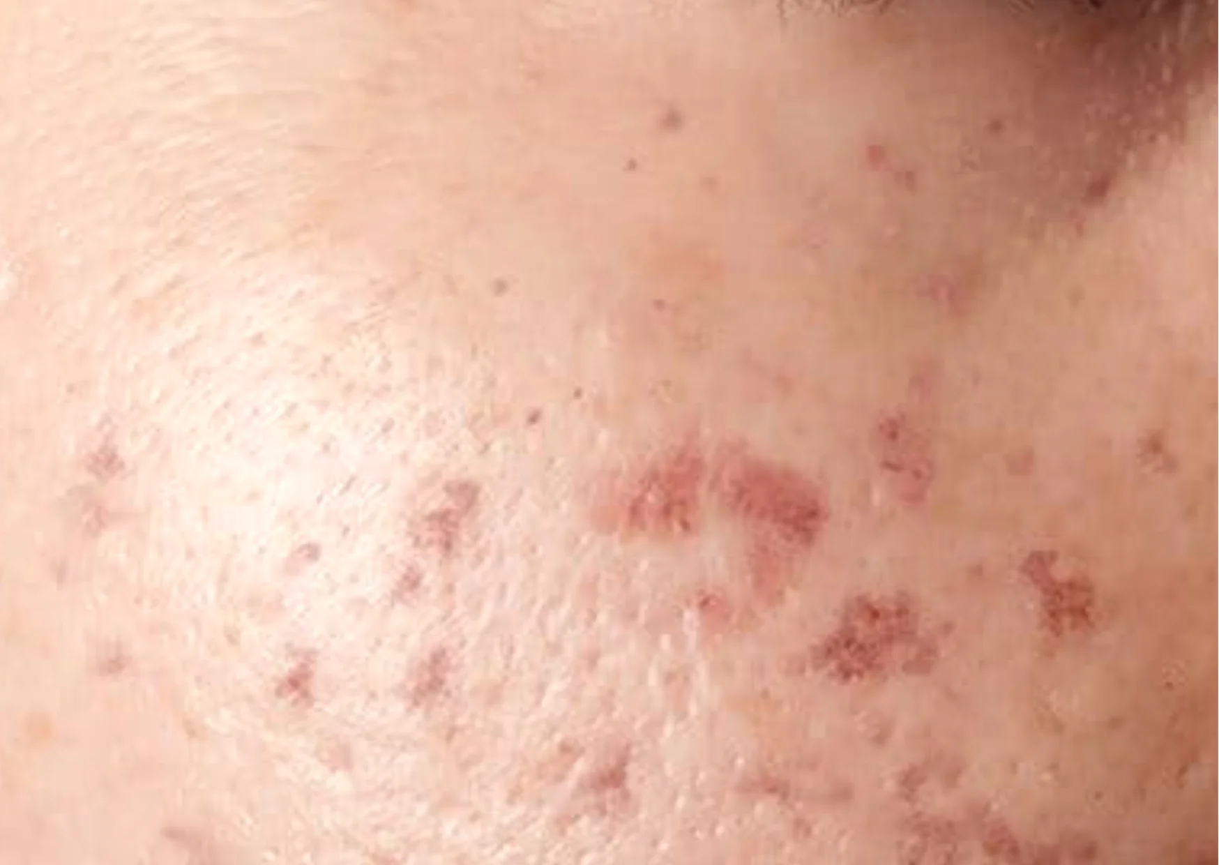 Post-Inflammatory Hyperpigmentation (PIH)