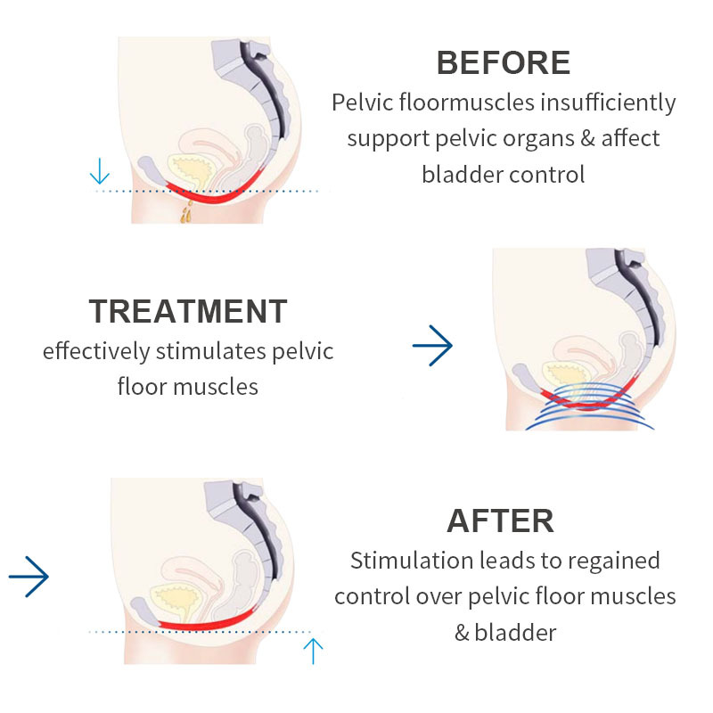 Osano Multifunctional Magchair Latest Pelvic Floor Machine Urinary Incontinence Pelvic Floor Machine