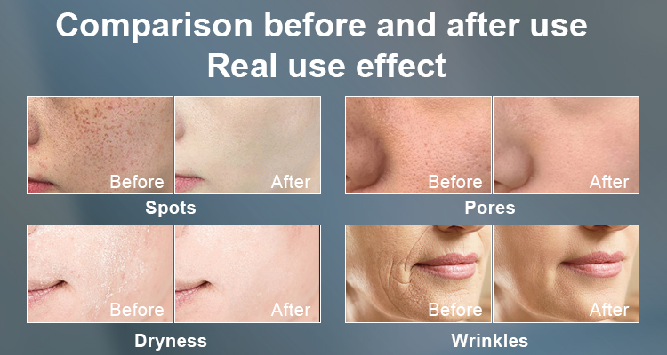 NIR DPL Skin Tightening & Hair Removal Before & After Result