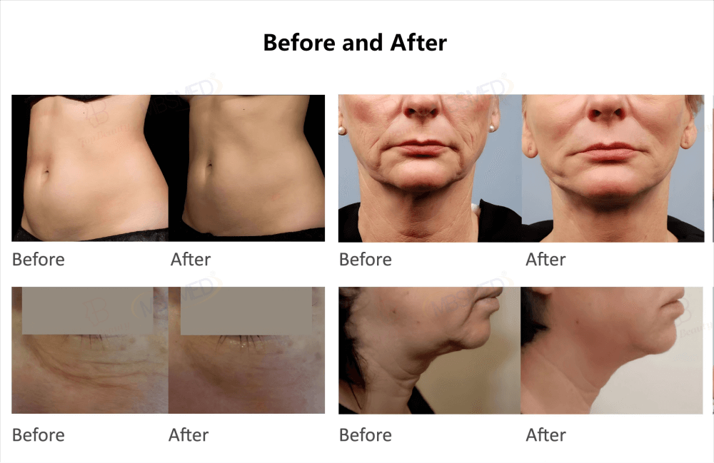 Before and After Result 7D HIFU & Thermage RF Machine