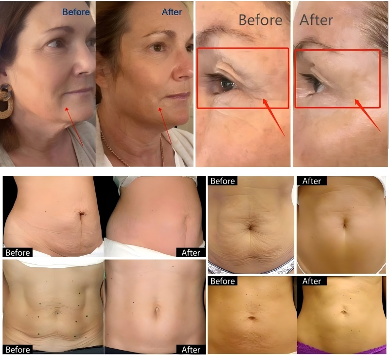 7D HIFU Vmax RF Treatment Before and After